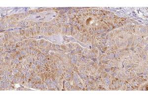 ABIN6267101 at 1/100 staining Human thyroid cancer tissue by IHC-P. (CAMKII gamma Antikörper  (pTyr231))