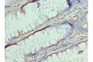 Immunohistochemistry of paraffin-embedded human colon cancer using ABIN7144363 at dilution of 1:100 (AP2B1 Antikörper  (AA 738-937))