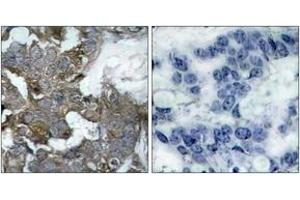 Immunohistochemistry analysis of paraffin-embedded human breast carcinoma tissue, using IkappaB-alpha (Ab-32/36) Antibody. (NFKBIA Antikörper  (AA 15-64))