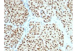 Formalin-fixed, paraffin-embedded human Melanoma stained with SOX10 Mouse Monoclonal Antibody (SOX10/991). (SOX10 Antikörper  (AA 115-269))