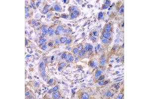 Immunohistochemistry of paraffin-embedded human esophageal cancer using SDHA antibody.