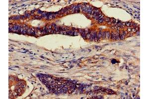 Immunohistochemistry of paraffin-embedded human colon cancer using ABIN7144852 at dilution of 1:100 (ATP5F1D Antikörper  (AA 32-158))