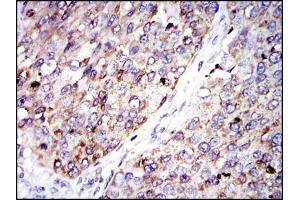Immunohistochemical analysis of paraffin-embedded kidney cancer tissues using G6PD mouse mAb with DAB staining. (Glucose-6-Phosphate Dehydrogenase Antikörper)