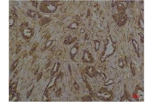 Immunohistochemical analysis of paraffin-embedded Human Breast Caricnoma using Phosphoserine Mouse mAb diluted at 1:200. (Phosphoserine Antikörper)