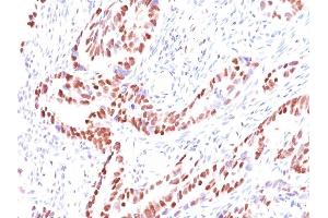 Formalin-fixed, paraffin-embedded human Colon Carcinoma stained with p57 Mouse Monoclonal Antibody (KIP2/880). (CDKN1C Antikörper)