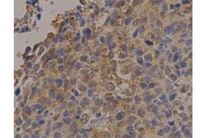 Immunohistochemical staining of human lung cancer with PGK1 monoclonal antibody, clone 14  at 1:100 dilution. (PGK1 Antikörper)