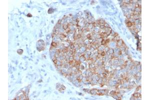 Formalin-fixed, paraffin-embedded human Prostate Carcinoma stained with STAT2 Mouse Monoclonal Antibody (STAT2/2650). (STAT2 Antikörper)