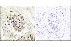 Immunohistochemistry analysis of paraffin-embedded human breast carcinoma tissue, using MED1 Antibody. (MED1 Antikörper  (AA 641-690))