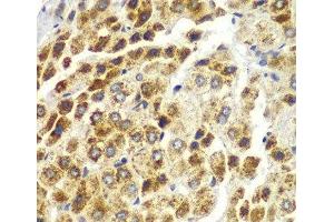 Immunohistochemistry of paraffin-embedded Human liver cancer using SND1 Polyclonal Antibody at dilution of 1:100 (40x lens). (SND1 Antikörper)