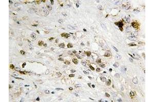Immunohistochemistry analyzes of FoxC1/2 antibody in paraffin-embedded human prostate carcinoma tissue. (FOXC1 Antikörper)