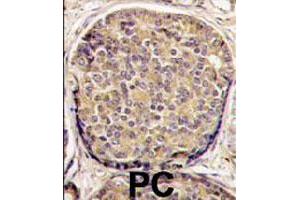 Formalin-fixed and paraffin-embedded human prostate carcinoma tissue reacted with PIK3CB polyclonal antibody  , which was peroxidase-conjugated to the secondary antibody, followed by DAB staining. (PIK3CB Antikörper  (C-Term))