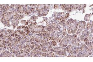 ABIN6273250 at 1/100 staining Human pancreas cancer tissue by IHC-P. (GPD2 Antikörper  (N-Term))