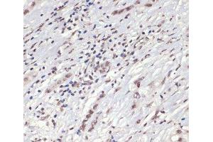 Immunohistochemistry of paraffin-embedded Human liver cancer using Phospho-Jak2(Y1007/1008) Polyclonal Antibody at dilution of 1:200 (40x lens). (JAK2 Antikörper  (pTyr1007, pTyr1008))