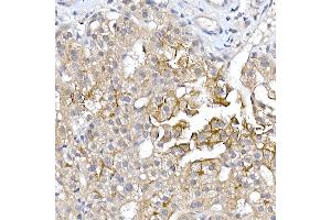 Immunohistochemistry of paraffin-embedded human liver cancer using  Rabbit pAb (ABIN6133588, ABIN6137055, ABIN6137056 and ABIN6224634) at dilution of 1:150 (40x lens). (AQP9 Antikörper  (AA 50-150))