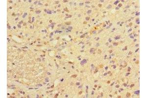 Immunohistochemistry of paraffin-embedded human glioma using ABIN7165067 at dilution of 1:100 (PRMT3 Antikörper  (AA 311-529))