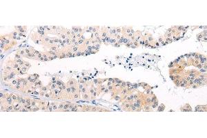 Immunohistochemistry of paraffin-embedded Human liver cancer tissue using ANAPC15 Polyclonal Antibody at dilution of 1:50(x200)