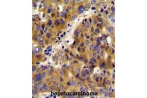 BCKDHB Antibody (N-term) immunohistochemistry analysis in formalin fixed and paraffin embedded human hepatocarcinoma followed by peroxidase conjugation of the secondary antibody and DAB staining.