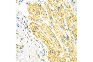 Immunohistochemistry of paraffin-embedded human gastric cancer using PTK6 antibody at dilution of 1:100 (x400 lens).