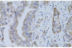 Immunohistochemistry of paraffin-embedded Human liver cancer using CDKN1A Polyclonal Antibody at dilution of 1:100 (40x lens). (p21 Antikörper)