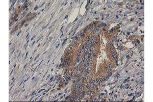 Immunohistochemical staining of paraffin-embedded Adenocarcinoma of Human colon tissue using anti-BCAR1 mouse monoclonal antibody. (BCAR1 Antikörper)