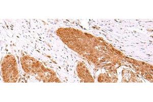 Immunohistochemistry of paraffin-embedded Human esophagus cancer tissue using FDPS Polyclonal Antibody at dilution of 1:60(x200) (FDPS Antikörper)