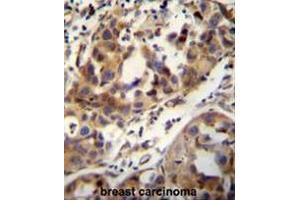 CCDC17 antibody (C-term) immunohistochemistry analysis in formalin fixed and paraffin embedded human breast carcinoma followed by peroxidase conjugation of the secondary antibody and DAB staining. (CCDC17 Antikörper  (C-Term))