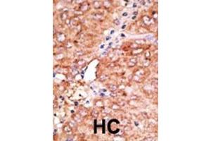 Formalin-fixed and paraffin-embedded human cancer tissue reacted with the primary antibody, which was peroxidase-conjugated to the secondary antibody, followed by AEC staining. (CCBP2 Antikörper  (C-Term))