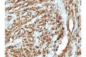 Formalin-fixed, paraffin-embedded human rhabdomyosarcoma stained with pan Muscle Actin antibody (HHF35 + MSA/953) (Pan Muscle Actin Antikörper)