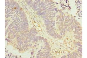 Immunohistochemistry of paraffin-embedded human ovarian cancer using ABIN7157306 at dilution of 1:100 (KLHDC5 Antikörper  (AA 1-410))