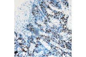 Immunohistochemical analysis of DACH1 staining in human colon cancer formalin fixed paraffin embedded tissue section. (DACH1 Antikörper)
