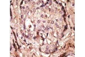 IHC analysis of FFPE human breast cancer tissue stained with the GFAP antibody