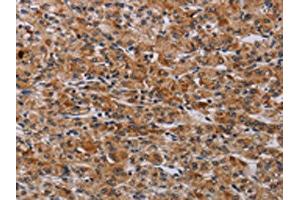 The image on the left is immunohistochemistry of paraffin-embedded Human prostate cancer tissue using ABIN7190614(F2RL2 Antibody) at dilution 1/30, on the right is treated with synthetic peptide. (F2RL2 Antikörper)