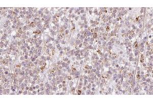 ABIN6273206 at 1/100 staining Human lymph cancer tissue by IHC-P. (CCDC93 Antikörper  (C-Term))
