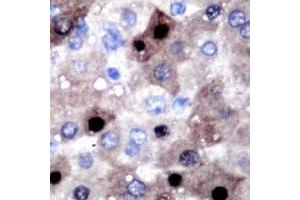 Immunohistochemical analysis of SULT2B1 staining in human liver cancer formalin fixed paraffin embedded tissue section. (SULT2B1 Antikörper)