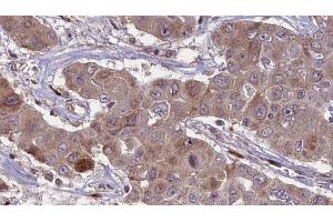 ABIN6269009 at 1/100 staining Human liver cancer tissue by IHC-P. (SLC2A3 Antikörper  (C-Term))