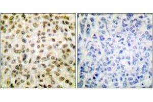 Immunohistochemistry analysis of paraffin-embedded human breast carcinoma tissue, using Histone H1 (Acetyl-Lys25) Antibody. (Histone H1 Antikörper  (acLys25))