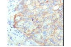 Immunohistochemical analysis of paraffin-embedded human cervical carcinoma, showing cytoplasmic localization with DAB staining using KARS mouse mAb. (KARS Antikörper  (AA 90-174))