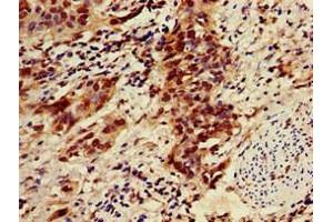 Immunohistochemistry of paraffin-embedded human bladder cancer using ABIN7176497 at dilution of 1:100 (ZNF695 Antikörper  (AA 1-88))