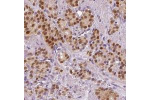 IHC analysis of paraffin-embedded human prostate cancer tissue, using SPOP antibody (1/200 dilution). (SPOP-B Antikörper)