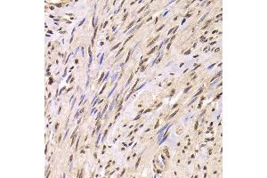 Immunohistochemistry of paraffin-embedded Human adenomyosis using SNRPA antibody at dilution of 1:100 (x400 lens). (SNRPA1 Antikörper)