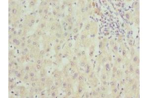 Immunohistochemistry of paraffin-embedded human liver cancer using ABIN7166597 at dilution of 1:100 (Small EDRK-Rich Factor 1A (SERF1A) (AA 140-240) Antikörper)