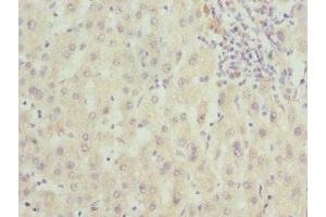 Immunohistochemistry of paraffin-embedded human liver cancer using ABIN7166597 at dilution of 1:100
