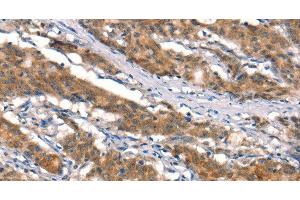 Immunohistochemistry of paraffin-embedded Human gastric cancer tissue using CUL4B Polyclonal Antibody at dilution 1:50 (Cullin 4B Antikörper)