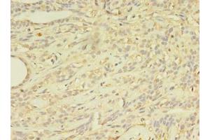 Immunohistochemistry of paraffin-embedded human breast cancer using ABIN7144889 at dilution of 1:100 (ABCB5 Antikörper  (AA 547-760))