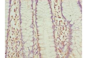 Immunohistochemistry of paraffin-embedded human colon cancer using ABIN7152521 at dilution of 1:100 (FAD Synthetase Antikörper  (AA 1-490))