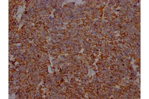 IHC image of ABIN7127670 diluted at 1:100 and staining in paraffin-embedded human lung cancer performed on a Leica BondTM system.