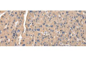 Immunohistochemistry of paraffin-embedded Human thyroid cancer tissue using ZFAND5 Polyclonal Antibody at dilution of 1:35(x200) (ZFAND5 Antikörper)