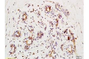 Formalin-fixed and human kidney carcinoma tissue labeled with Anti-phospho-BACH1/BRIP1(Ser990) Polyclonal Antibody, Unconjugated  at 1:200 followed by conjugation to the secondary antibody and DAB staining (BRIP1 Antikörper  (pSer990))
