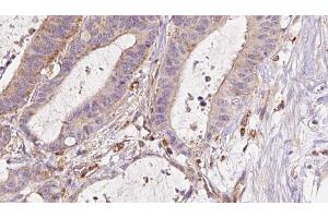 ABIN6273044 at 1/100 staining Human liver cancer tissue by IHC-P. (ETFB Antikörper  (Internal Region))