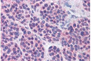 Anti-MBOAT4 antibody  ABIN960793 IHC staining of human thyroid, medullary carcinoma. (MBOAT4 Antikörper  (Internal Region))